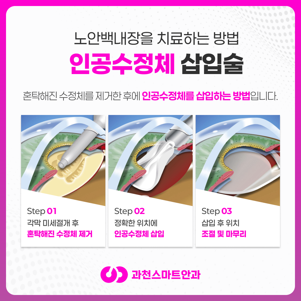 과천노안백내장 안내 이미지 5