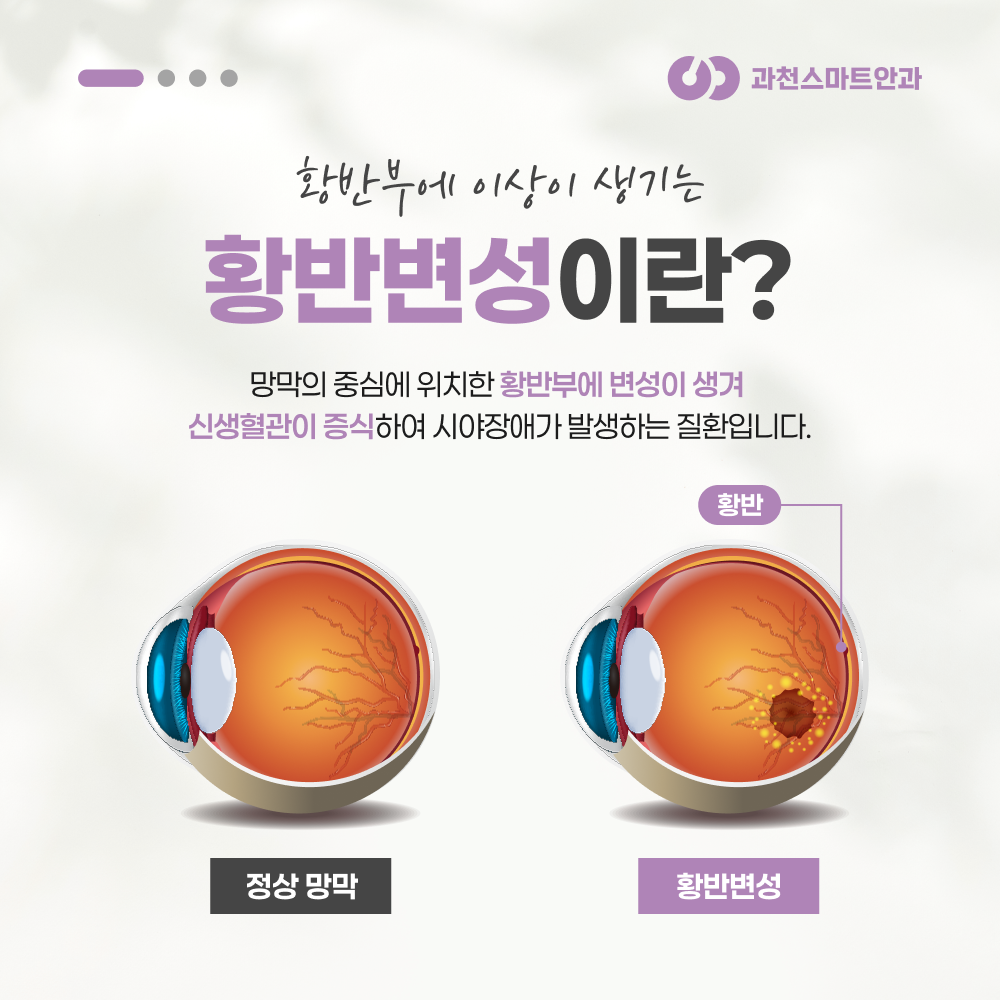 과천안과 망막 빛간섭단층촬영 검사 이미지