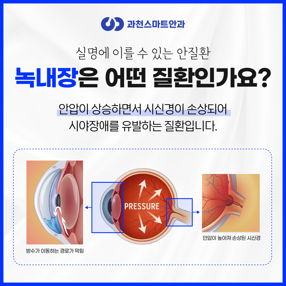 과천녹내장 안내 이미지 2