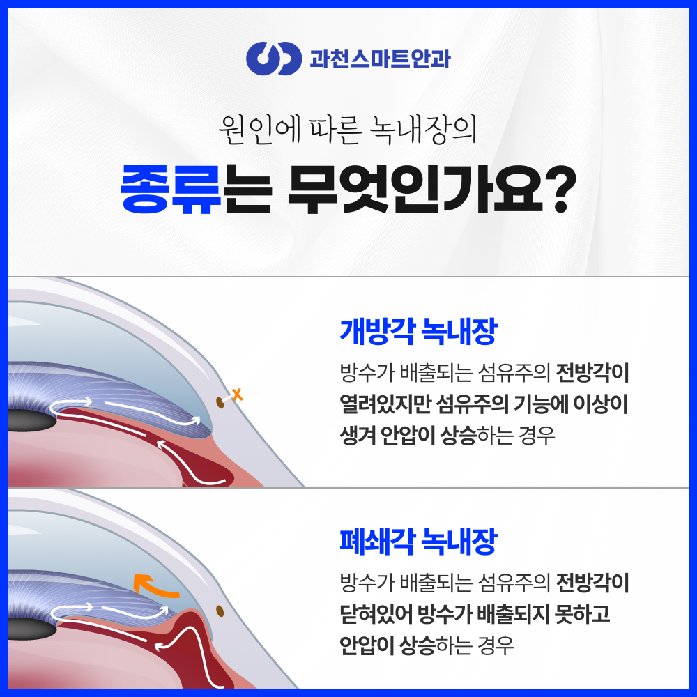 과천녹내장 안내 이미지 3