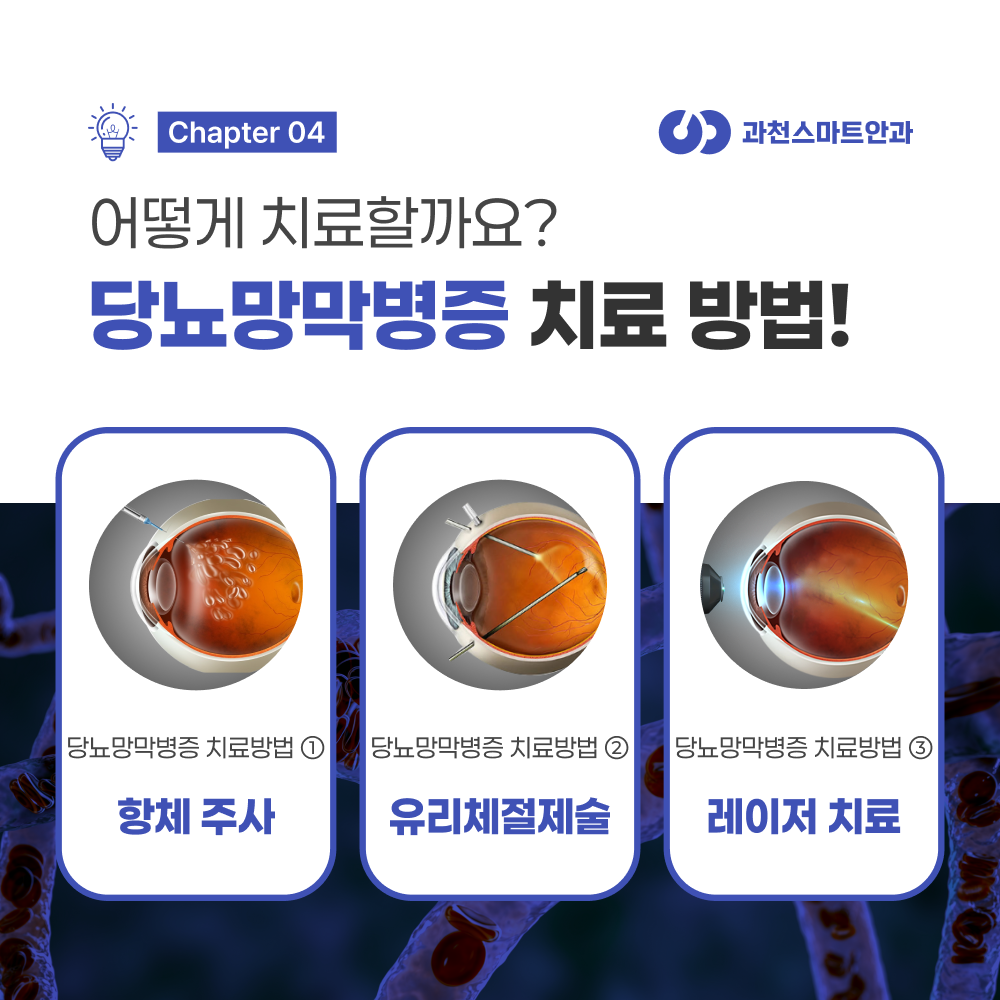 과천망막수술 유리체절제술 안내 이미지