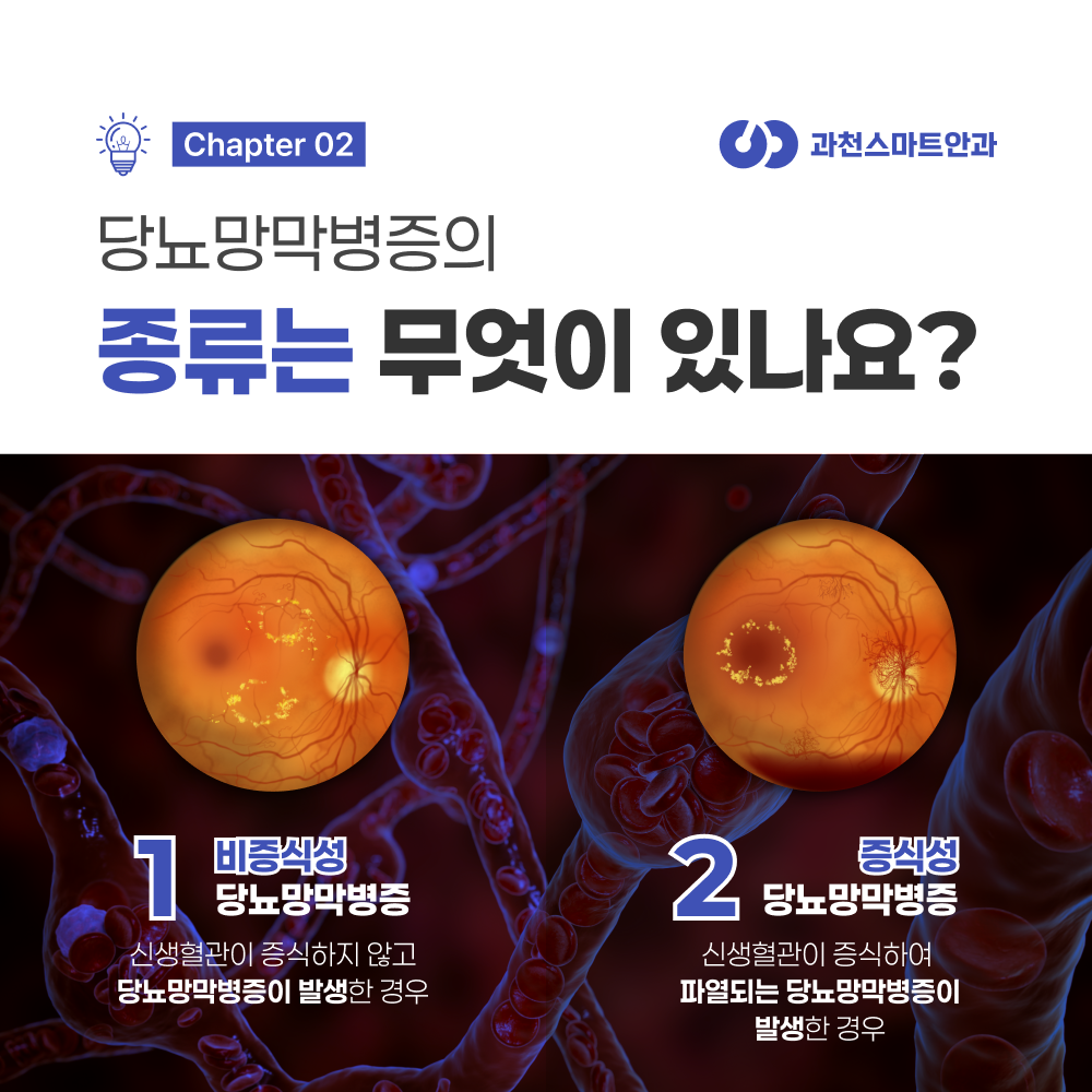 과천비증식성당뇨망막병증 초기 단계 설명 이미지